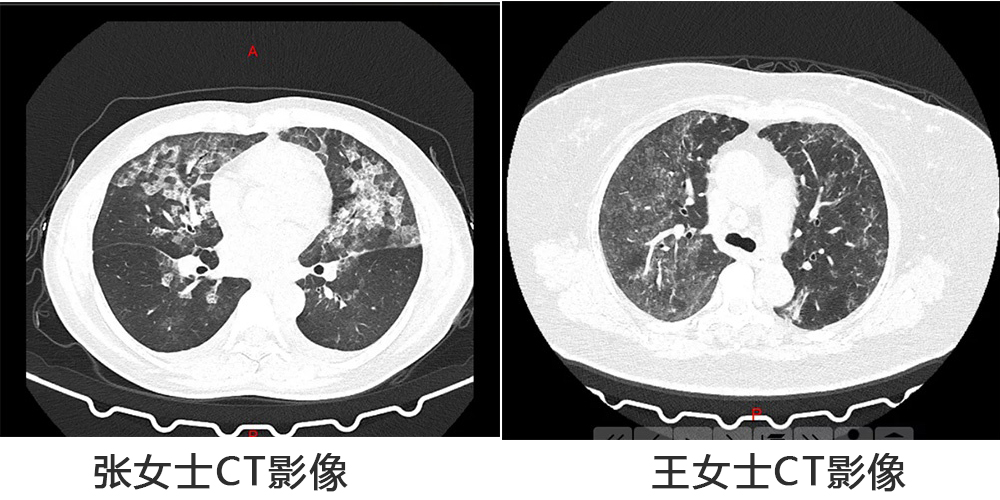 消毒過量，河南兩女子肺部CT呈現(xiàn)毛玻璃狀！